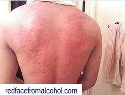 Picture of Red rash on back from alcohol allergy.